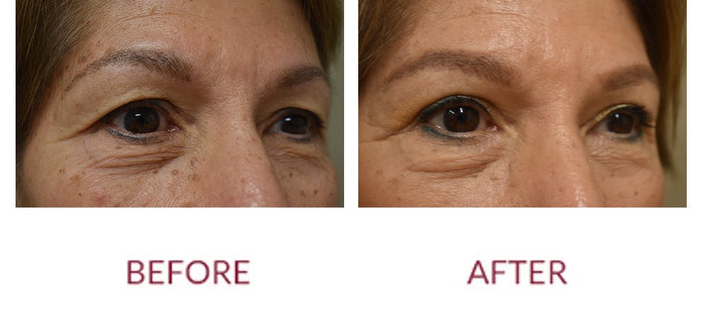 Eyelid Surgery Before & After Gallery - Patient 121753 - Image 2