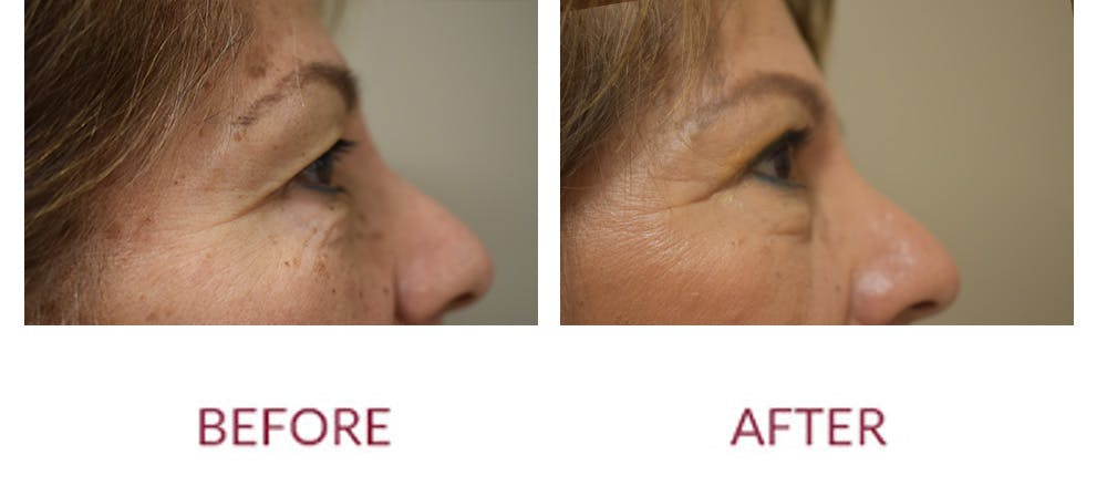 Eyelid Surgery Before & After Gallery - Patient 121753 - Image 3
