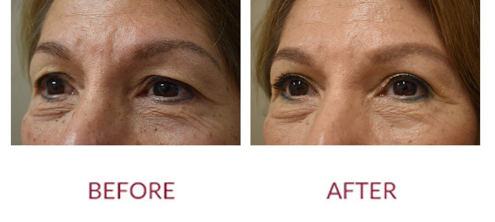 Eyelid Surgery Before & After Gallery - Patient 121753 - Image 4
