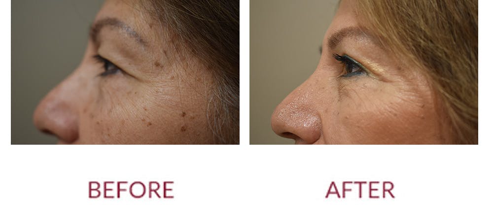 Eyelid Surgery Before & After Gallery - Patient 121753 - Image 5