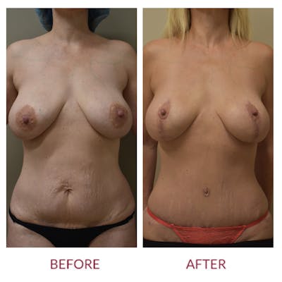 Tummy Tuck Before & After Gallery - Patient 157821 - Image 1