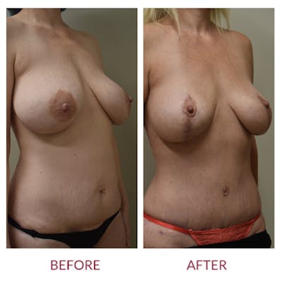 Tummy Tuck Before & After Gallery - Patient 157821 - Image 2