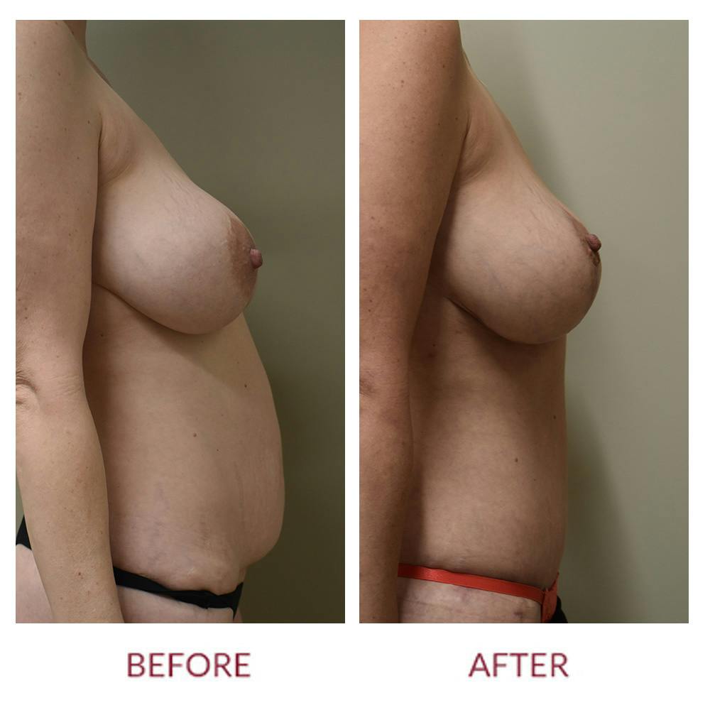 Tummy Tuck Before & After Gallery - Patient 157821 - Image 3