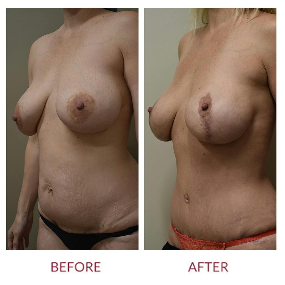 Tummy Tuck Before & After Gallery - Patient 157821 - Image 4
