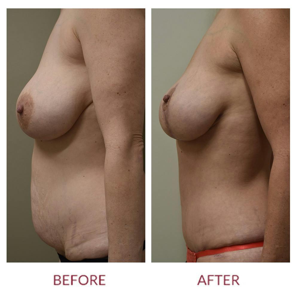 Tummy Tuck Before & After Gallery - Patient 157821 - Image 5