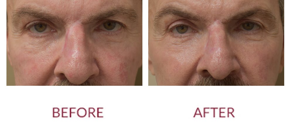 Scar Revision Before & After Gallery - Patient 783947 - Image 1