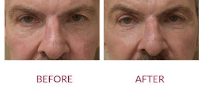 Scar Revision Before & After Gallery - Patient 783947 - Image 1