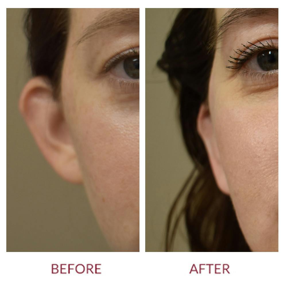 Otoplasty Before & After Gallery - Patient 374550 - Image 1