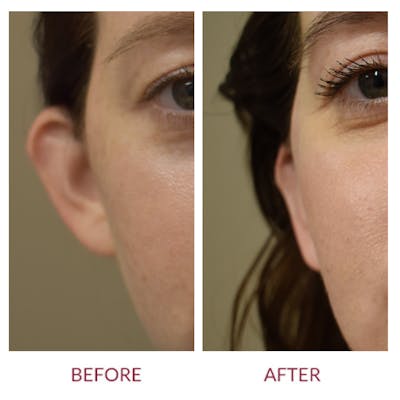 Otoplasty Before & After Gallery - Patient 374550 - Image 1