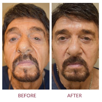 Nasolabial Fold Before & After Gallery - Patient 358095 - Image 1