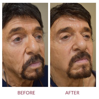 Nasolabial Fold Before & After Gallery - Patient 358095 - Image 2