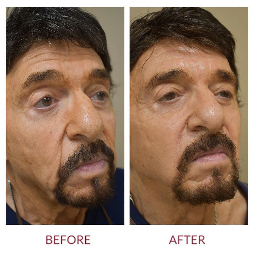 Nasolabial Fold Before & After Gallery - Patient 358095 - Image 2