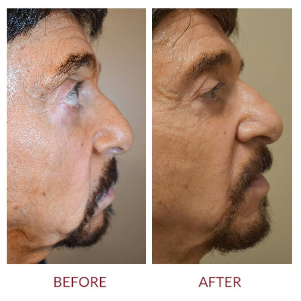 Nasolabial Fold Before & After Gallery - Patient 358095 - Image 3