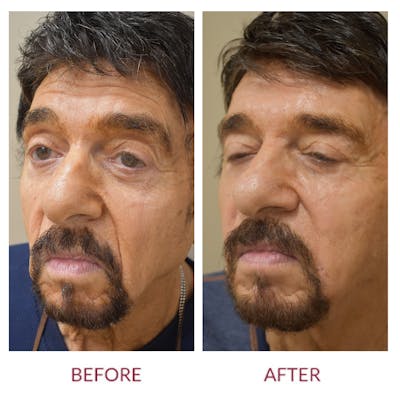 Nasolabial Fold Before & After Gallery - Patient 358095 - Image 4