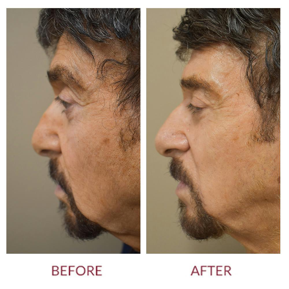 Nasolabial Fold Before & After Gallery - Patient 358095 - Image 5