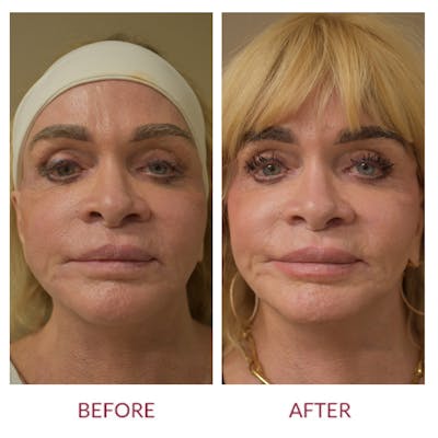 Facelift Before & After Gallery - Patient 276363 - Image 1