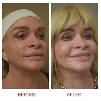 Co2 Laser Resurfacing Before & After Gallery - Patient 159581 - Image 2