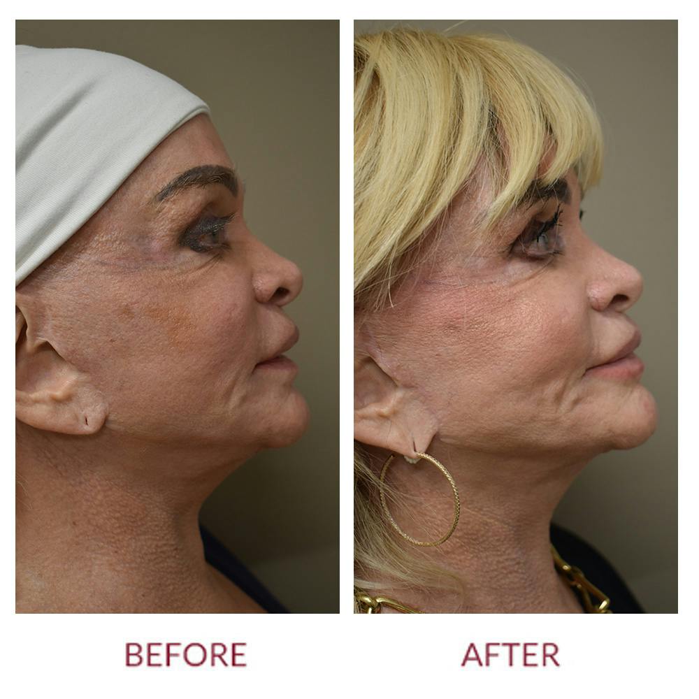 Co2 Laser Resurfacing Before & After Gallery - Patient 159581 - Image 3