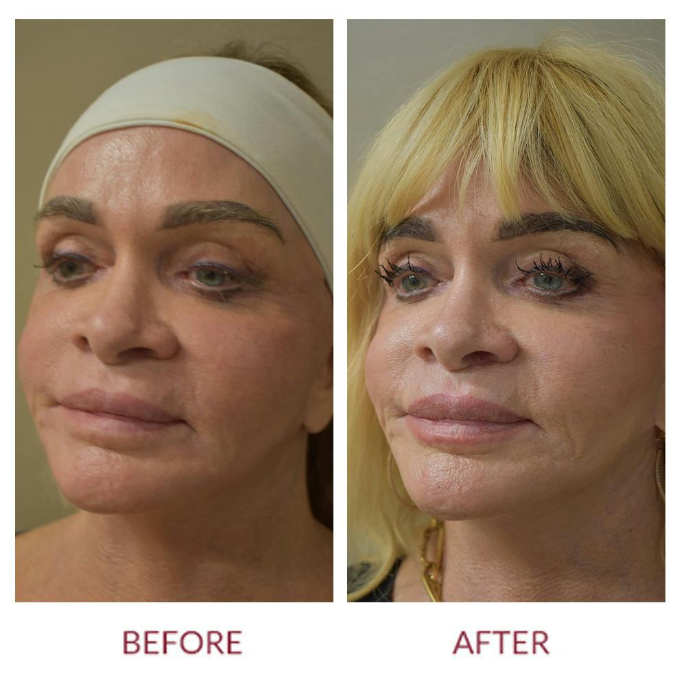 Lip Lift Before & After Gallery - Patient 945981 - Image 4