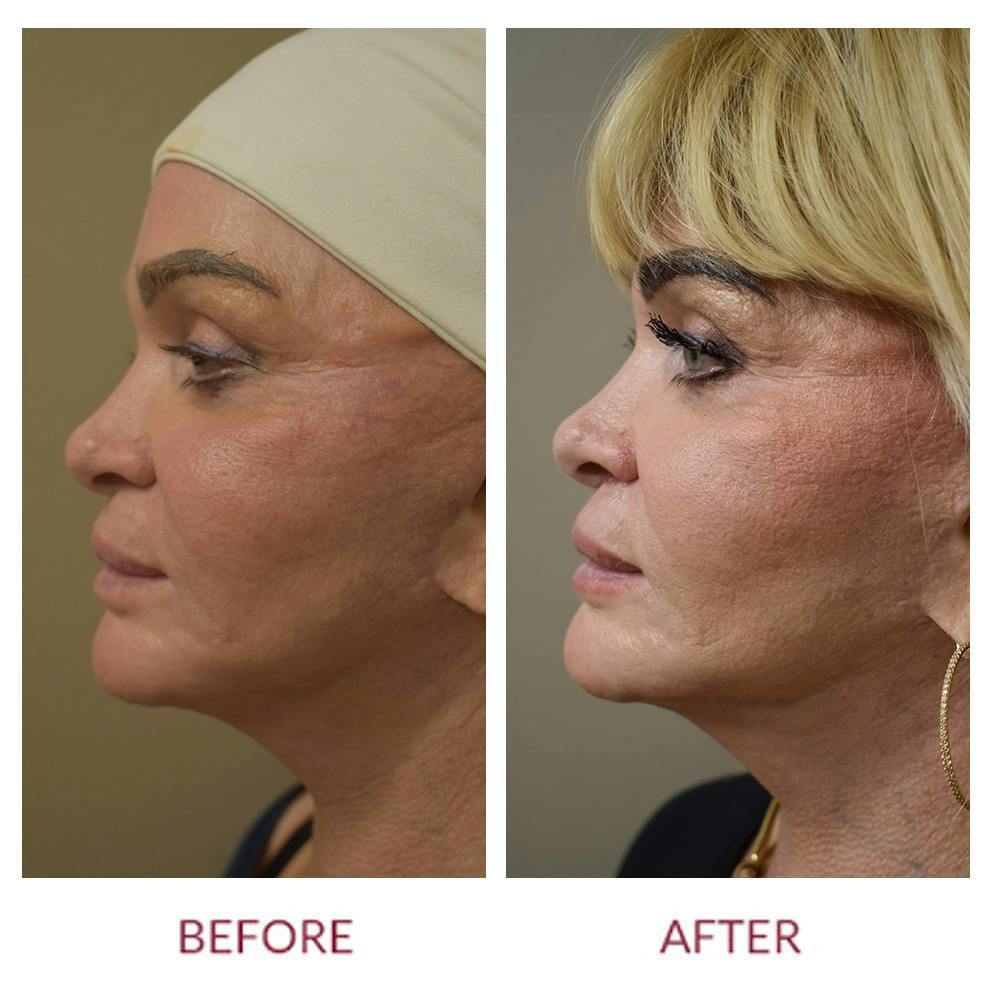 Lip Lift Before & After Gallery - Patient 945981 - Image 5