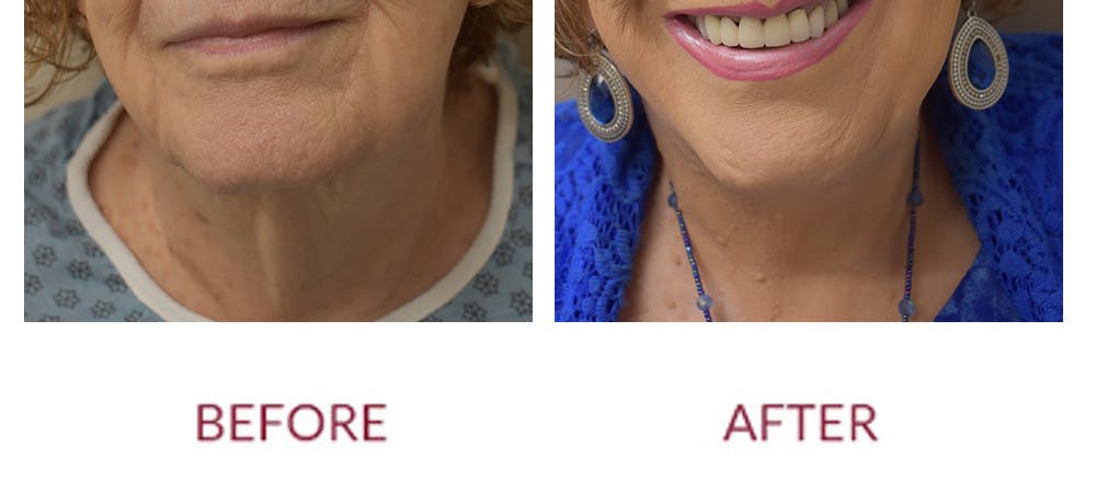 Facelift Before & After Gallery - Patient 186503 - Image 1