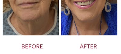 Facelift Before & After Gallery - Patient 186503 - Image 1