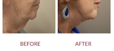 Facelift Before & After Gallery - Patient 186503 - Image 2