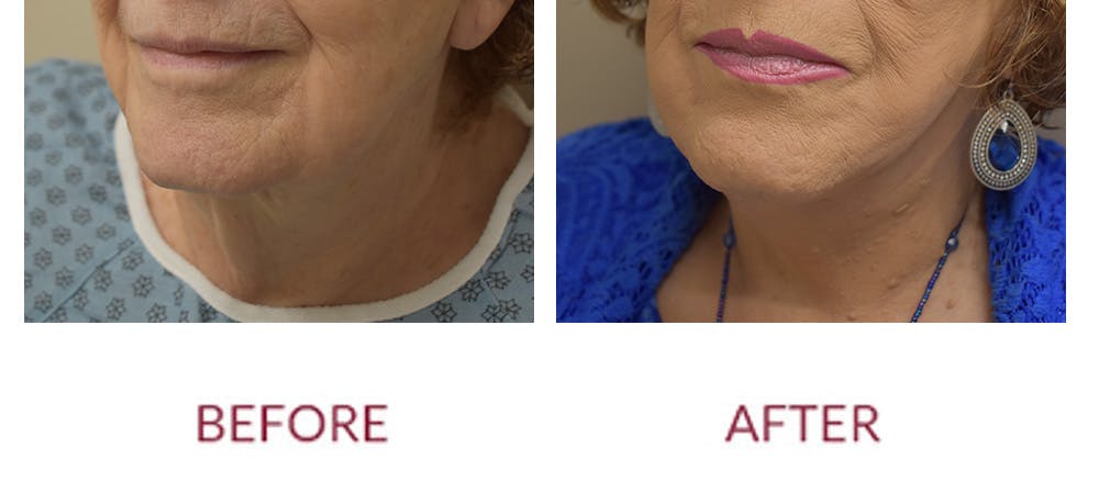 Facelift Before & After Gallery - Patient 186503 - Image 3