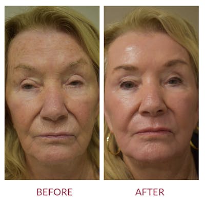 Co2 Laser Resurfacing Before & After Gallery - Patient 372411 - Image 1