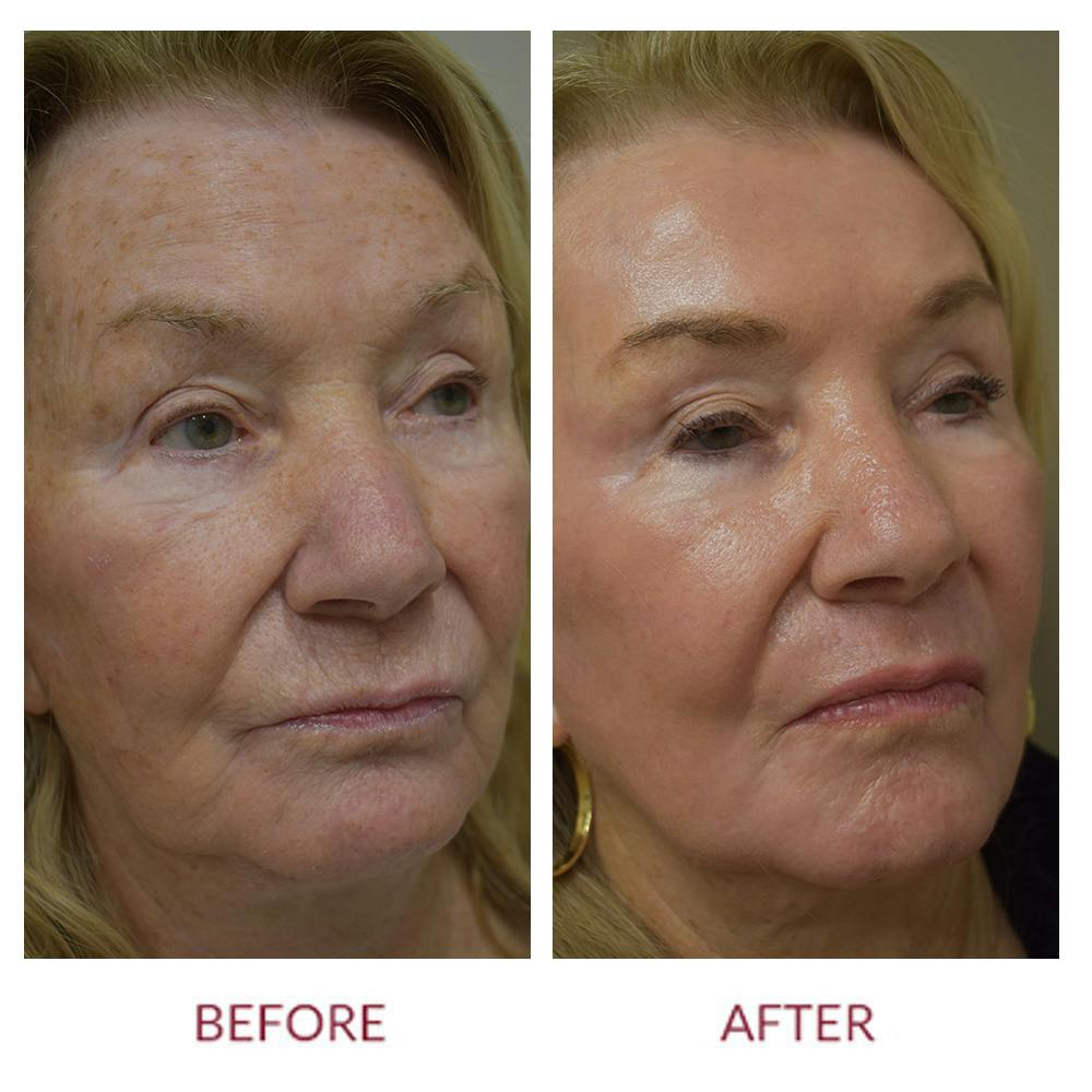 Co2 Laser Resurfacing Before & After Gallery - Patient 372411 - Image 2