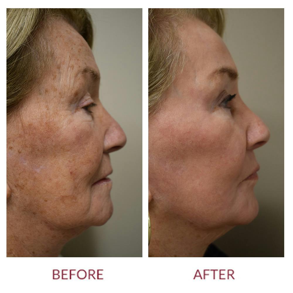 Co2 Laser Resurfacing Before & After Gallery - Patient 372411 - Image 3