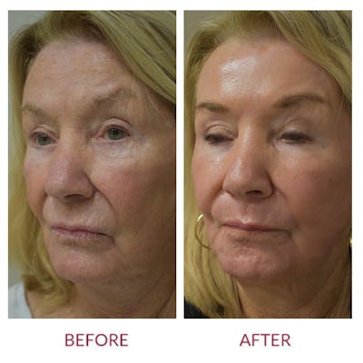Co2 Laser Resurfacing Before & After Gallery - Patient 372411 - Image 4