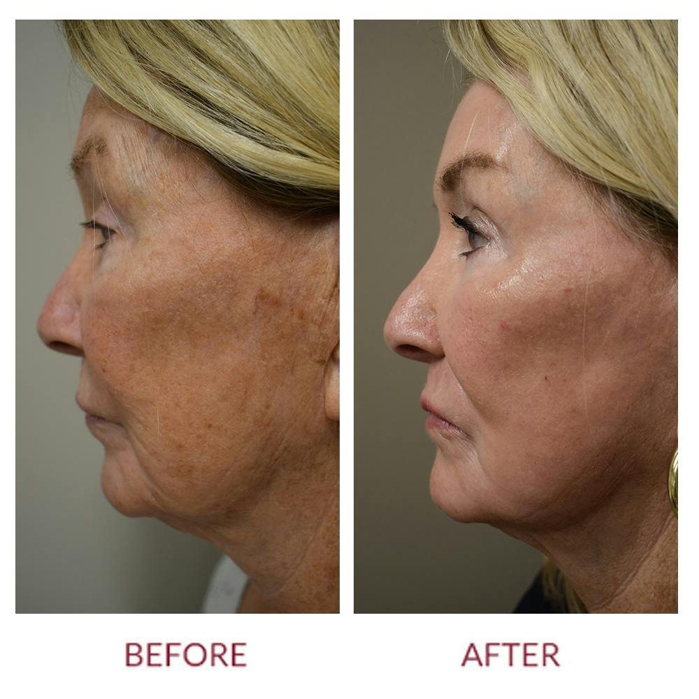 Co2 Laser Resurfacing Before & After Gallery - Patient 372411 - Image 5