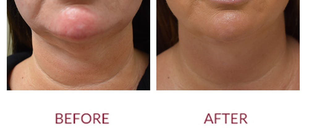 Chin Augmentation Before & After Gallery - Patient 269390 - Image 1