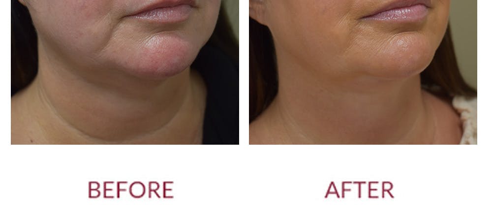Chin Augmentation Before & After Gallery - Patient 269390 - Image 2