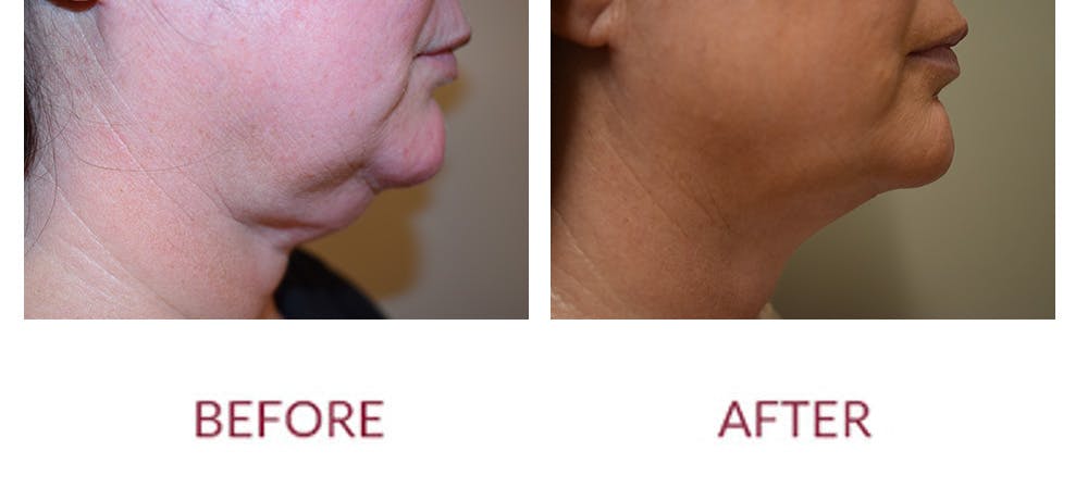 Chin Augmentation Before & After Gallery - Patient 269390 - Image 3