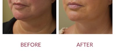 Chin Augmentation Before & After Gallery - Patient 269390 - Image 4