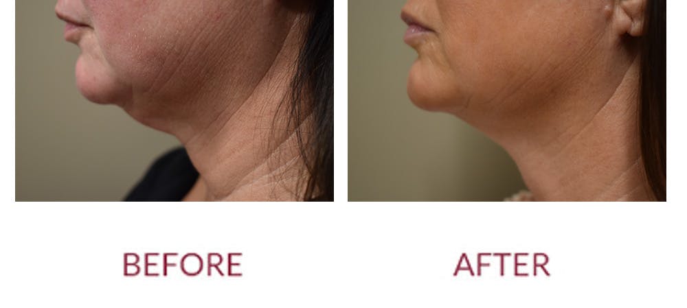Chin Augmentation Before & After Gallery - Patient 269390 - Image 5