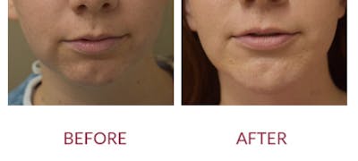 Chin Augmentation Before & After Gallery - Patient 303911 - Image 1