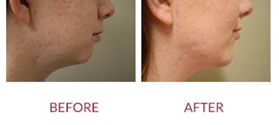 Chin Augmentation Before & After Gallery - Patient 303911 - Image 2