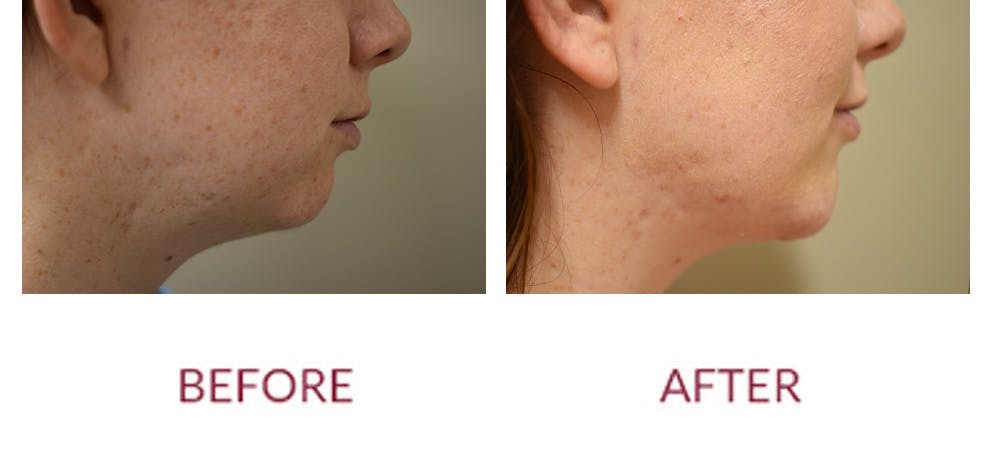 Chin Augmentation Before & After Gallery - Patient 303911 - Image 2
