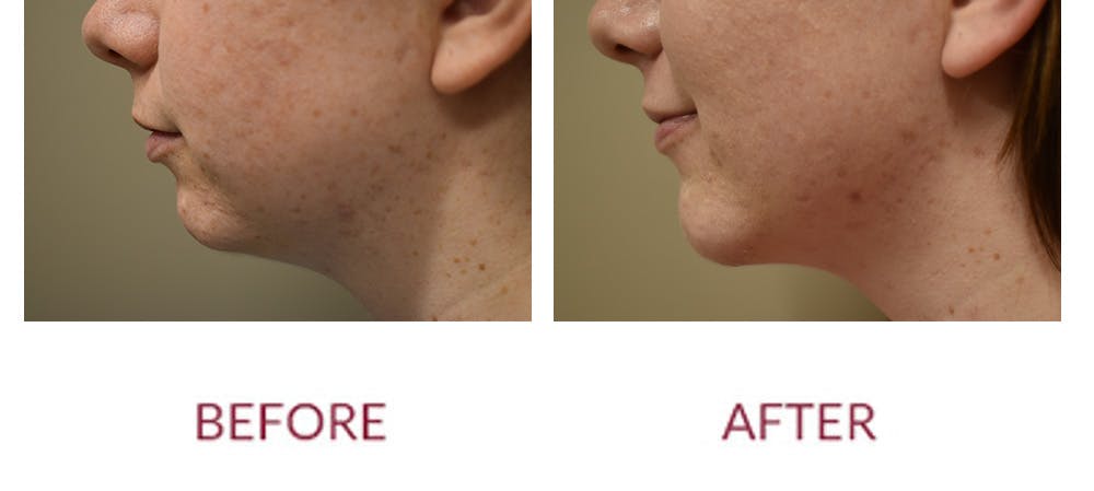 Chin Augmentation Before & After Gallery - Patient 303911 - Image 3