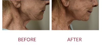 Cheek Lift Before & After Gallery - Patient 219812 - Image 1