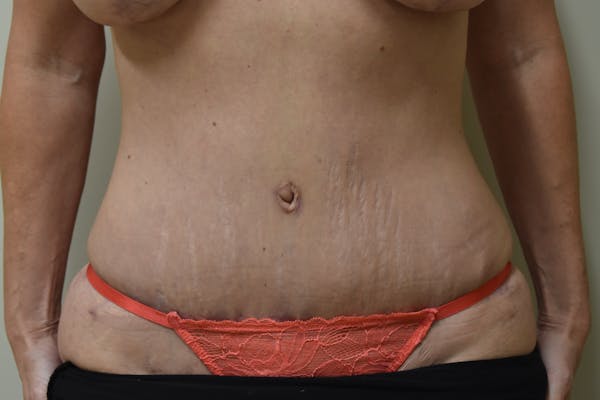 Tummy Tuck Before & After Gallery - Patient 205383 - Image 2