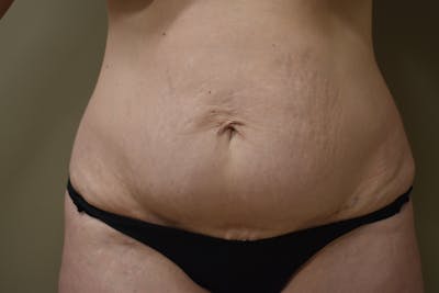 Tummy Tuck Before & After Gallery - Patient 205383 - Image 1