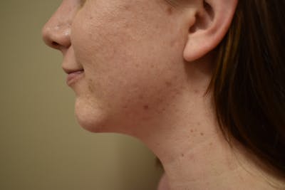 Chin Augmentation Before & After Gallery - Patient 363995 - Image 4