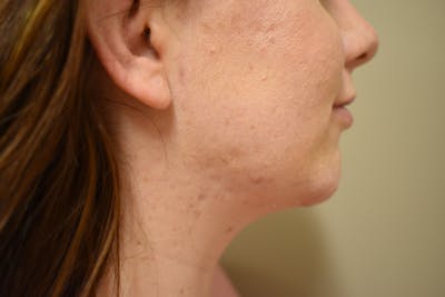 Otoplasty Before & After Gallery - Patient 249122 - Image 2