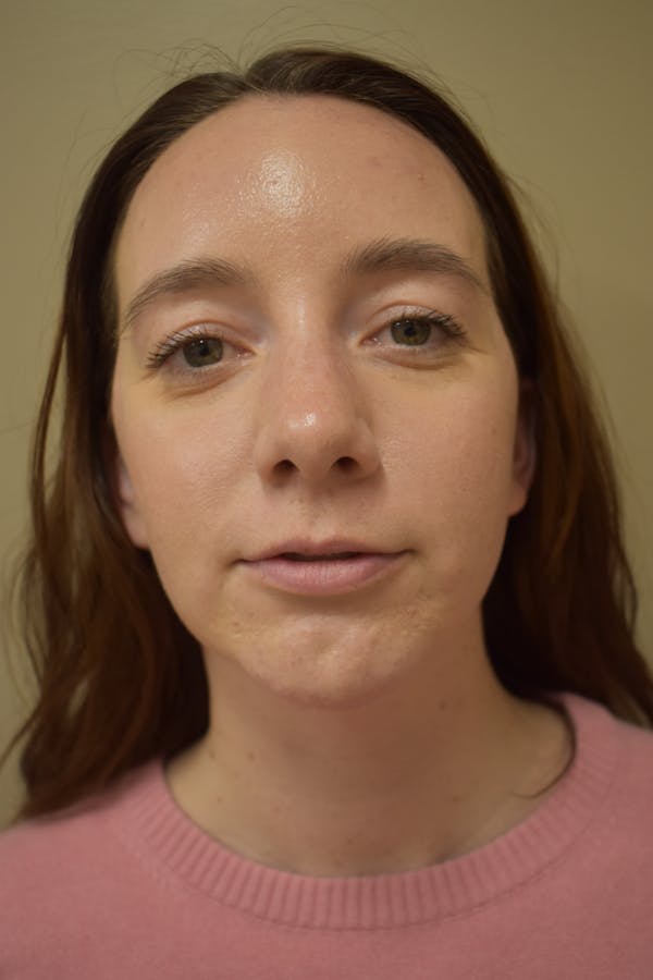 Chin Augmentation Before & After Gallery - Patient 363995 - Image 2