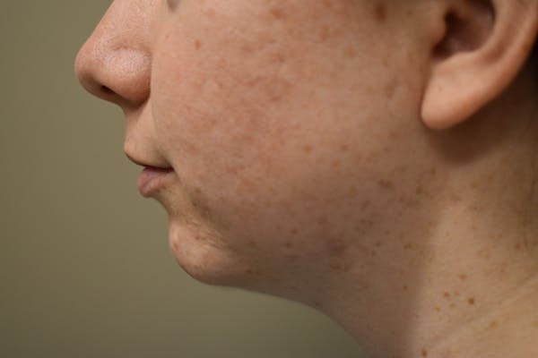 Chin Augmentation Before & After Gallery - Patient 363995 - Image 3