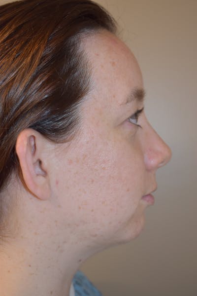 Otoplasty Before & After Gallery - Patient 249122 - Image 1
